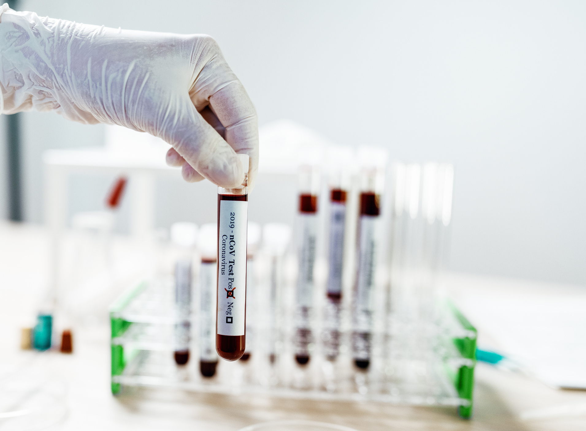 COVID-19 positive test - laboratory exam of blood sample